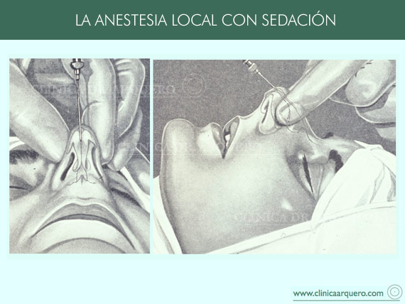 anestesia2