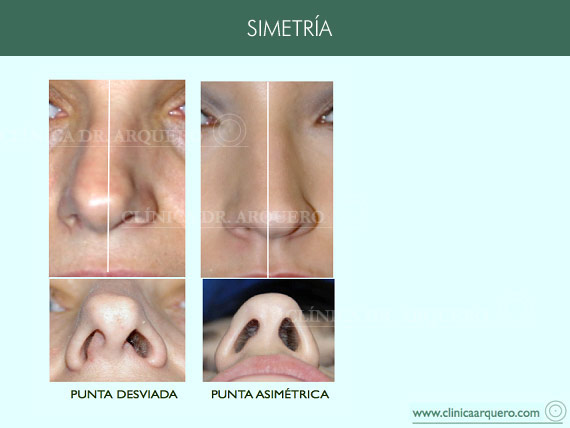 alteraciones_simetria