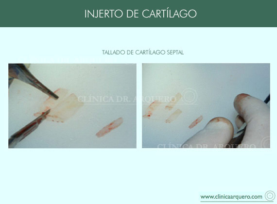 injerto_cartilago