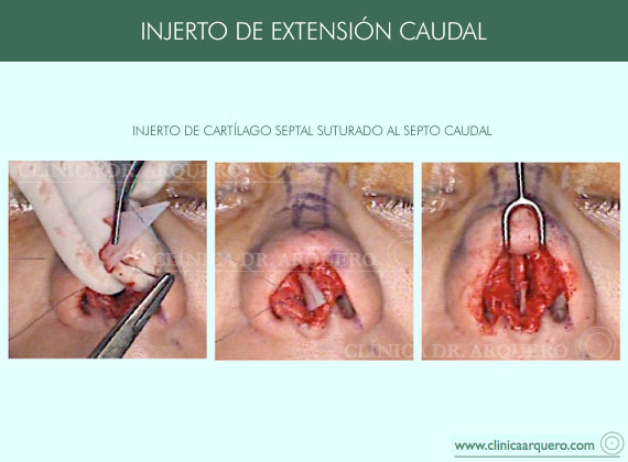 injerto_extension_caudal