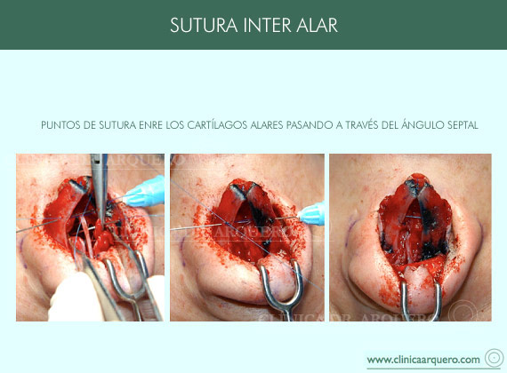 sutura_interalar