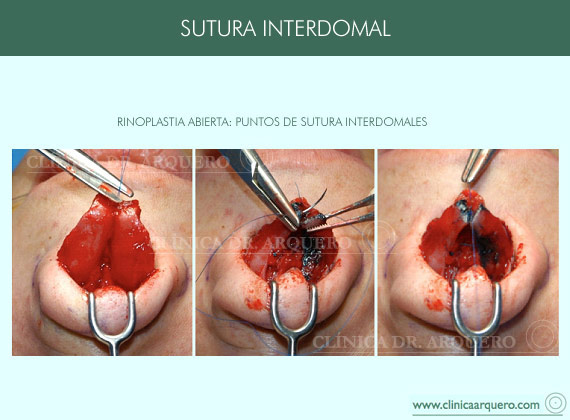 sutura_interdomal