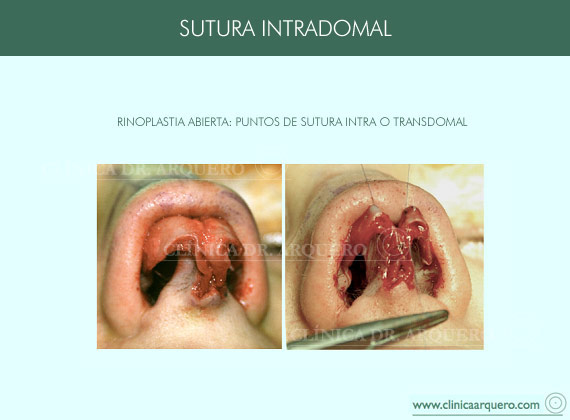 sutura_intradomal