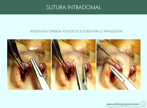 sutura_intradomal2